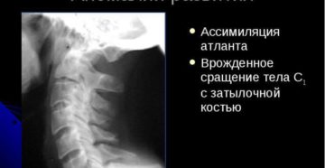 Врожденная аномалия сращения шейного отдела позвоночника. Лечение ассимиляции атланта. Симптомы ассимиляции атланта