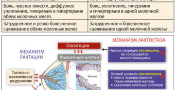 Лактостаз и мастит - в чем отличие. Чем схожи и чем отличаются мастит и лактостаз