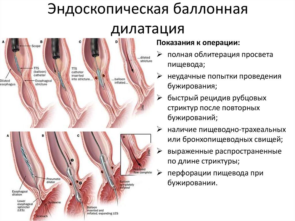 Эндоскопическая баллонная дилатация кардиального сфинктера. Нейромускулярные дисфункции пищевода Баллонная дилатация желудка