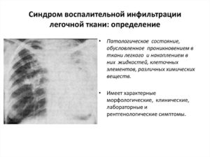 Инфильтрат в легких: что это такое? Что такое инфильтрация лёгочной ткани