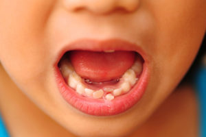 Чем вырвать молочный зуб. Как выдернуть молочный зуб ребенку в домашних условиях без боли