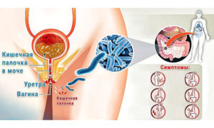 Кишечная палочка у мужчин — симптомы, причины, лечение. Кишечная палочка во влагалище