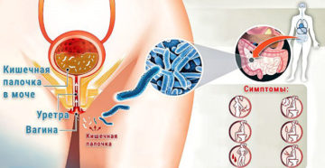 Кишечная палочка у мужчин — симптомы, причины, лечение. Кишечная палочка во влагалище