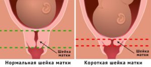 Что если шейка матки короткая. Опасно ли укорочение шейки матки при беременности и почему возникает это состояние