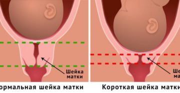 Что если шейка матки короткая. Опасно ли укорочение шейки матки при беременности и почему возникает это состояние