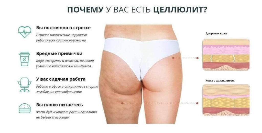 Причины возникновения целлюлита. Причины появления целлюлита у женщин