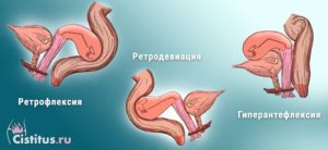 Почему происходит ретродевиация матки и как с ней бороться? Что такое ретродевиация матки, и какая она бывает