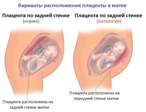 Локализация плаценты передняя стенка матки высоко. Расположение плаценты по передней и задней стенке матки