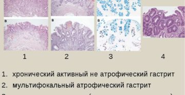 Очаговая неполная кишечная метаплазия лечение. Полная и неполная кишечная метаплазия: причины возникновения, симптомы, диагностика, лечение и профилактика. Причинами возникновения являются