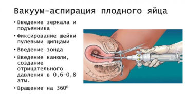 Сколько раз можно делать вакуум аспирацию. Как делают вакуумный аборт и какие могут быть последствия? Секс после вакуумного аборта