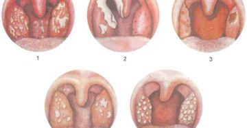 Постоянные гнойники на миндалинах. По каким причинам могут появляться язвы на гландах