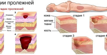 Предупреждение пролежней и опрелостей. Опрелости у лежачих больных: причины, стадии, лечение
