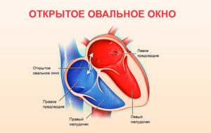 Овальное окно 9 лет может ли закрыться. Если у ребенка обнаружили открытое овальное окно в сердце