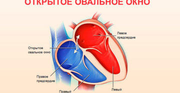 Овальное окно 9 лет может ли закрыться. Если у ребенка обнаружили открытое овальное окно в сердце