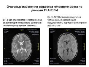 Дистрофические очаги в белом веществе головного мозга. Очаговые изменения вещества мозга дистрофического характера