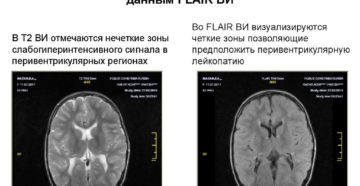 Дистрофические очаги в белом веществе головного мозга. Очаговые изменения вещества мозга дистрофического характера