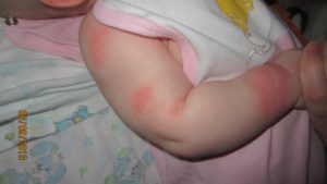 Прививки акдс и полиомиелит у ребенка: можно ли купать после вакцинации? Можно ли купать ребенка после прививки
