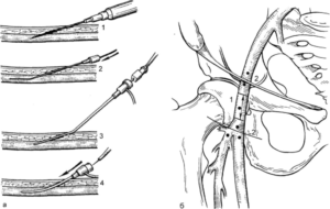 Катетеризация крупных сосудов по сельдингеру. Пункция бедренной артерии по сельдингеру. Пункция магистральных сосудов. Методика Сельдингера