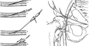 Катетеризация крупных сосудов по сельдингеру. Пункция бедренной артерии по сельдингеру. Пункция магистральных сосудов. Методика Сельдингера