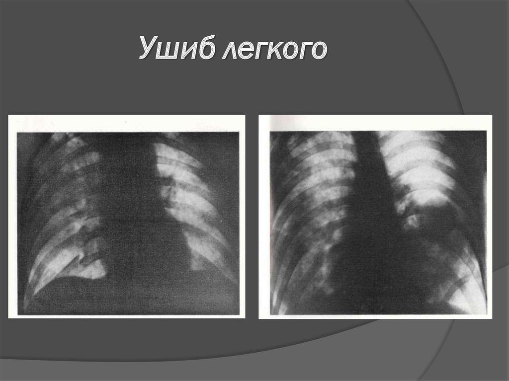 Лечение повреждений легких. Сильный ушиб легкого: симптомы и лечение