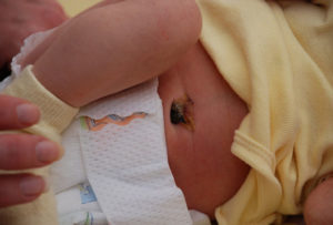 Омфалит у новорожденного: профилактика и лечение