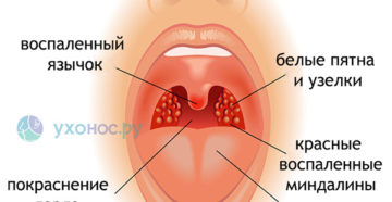 Как лечить волдыри на задней стенке в горле. Волдыри в горле — что это, как лечить, причины