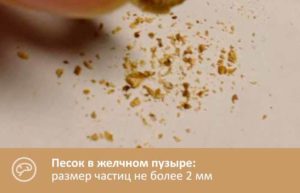 Как народными средствами вывести песок из желчного пузыря? Песок в желчном пузыре: симптомы и лечение