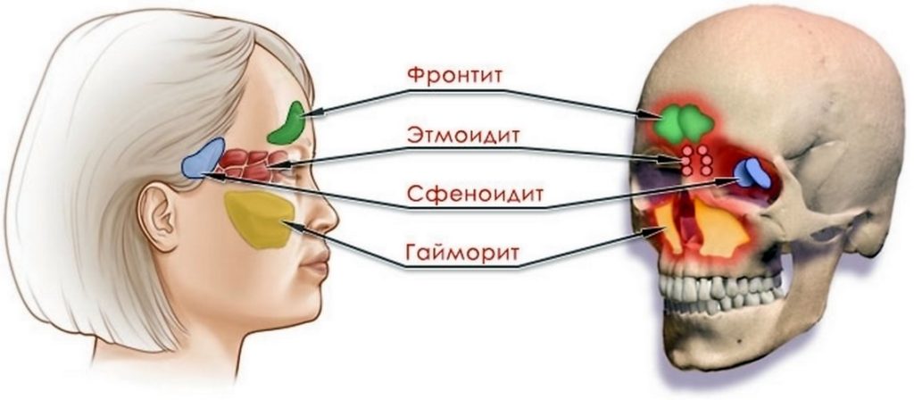 Сфеноидит последствия. Что такое сфеноидит? Поражение черепно-мозговых нервов