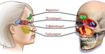 Сфеноидит последствия. Что такое сфеноидит? Поражение черепно-мозговых нервов