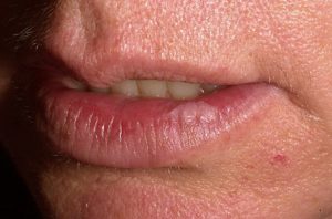 Красная окантовка вокруг губ. Болезни губ – причины, симптомы, лечение. Лечение воспаления уголков губ