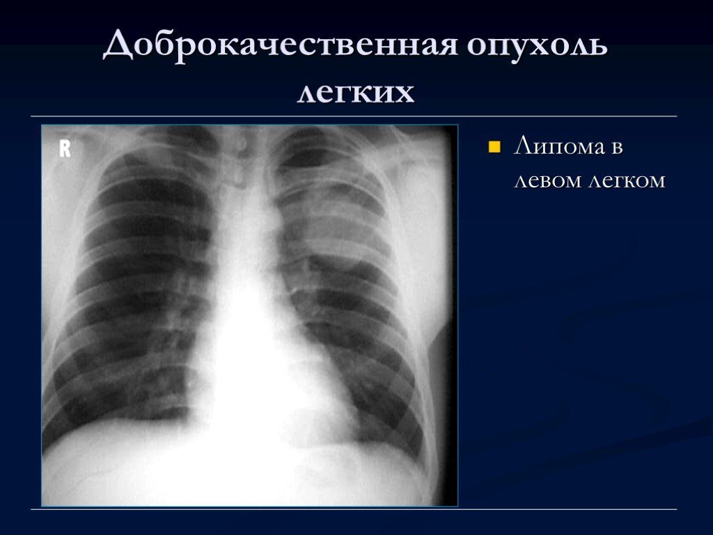 Доброкачественная опухоль легкого прогноз. Доброкачественные опухоли легких симптомы и лечение