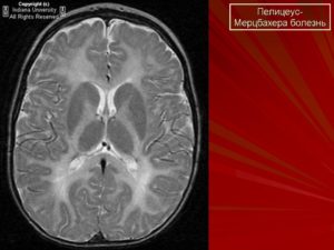 Лейкодистрофия (прогрессирующий склероз мозга). Что за болезнь лейкодистрофия Пелицеуса — Мерцбахера? Лейкодистрофия симптомы