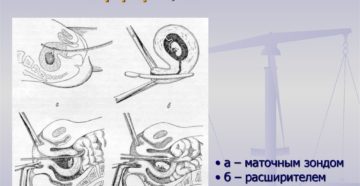 Накажут ли врача после перфорации матки. Перфорация матки – осложнение гинекологической операции. Тревожные симптомы при перфорации матки