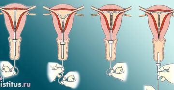 Первые месячные после установки спирали. Спираль мирена и месячные