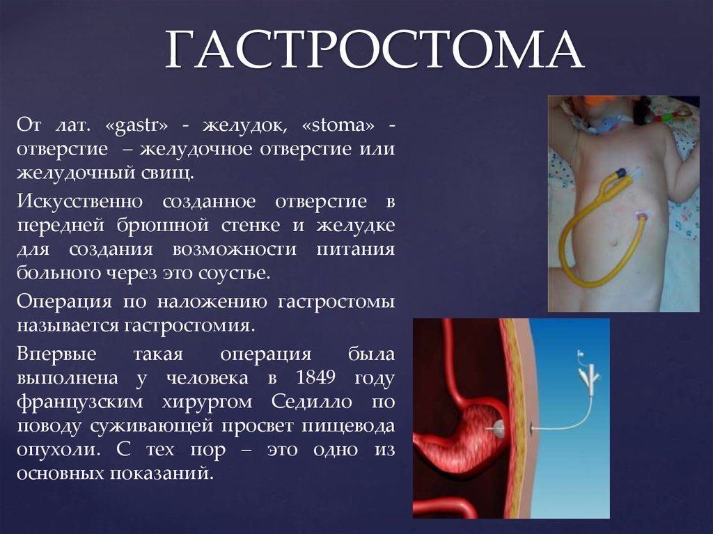 Гастростомия показания. Наложение гастростомы (гастростомия): показания, проведение, жизнь после. Подготовка к гастростомии