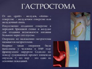 Гастростомия показания. Наложение гастростомы (гастростомия): показания, проведение, жизнь после. Подготовка к гастростомии