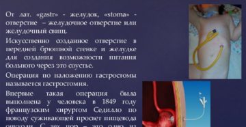 Гастростомия показания. Наложение гастростомы (гастростомия): показания, проведение, жизнь после. Подготовка к гастростомии