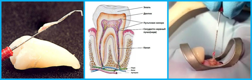Продуло и заболел зуб. Лечение застуженного зубного нерва