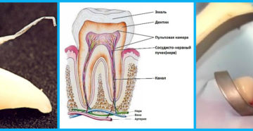 Продуло и заболел зуб. Лечение застуженного зубного нерва