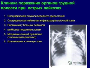 Воспаление легких при лейкозе лечение. Острый лейкоз. Акции и специальные предложения