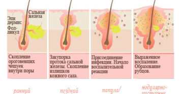 Прыщи и угри — в чем разница? Отличия и способы лечения. Почему они появляются. Из зелёного чая