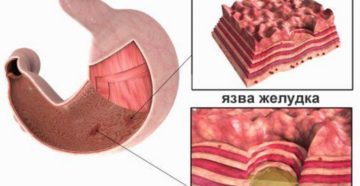 Эрозивно язвенные поражения желудочно кишечного тракта. Эрозия желудка — поражение слизистой оболочки с опасными последствиями
