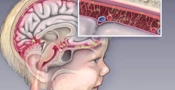 Инфекционные заболевания головного мозга: лечение и симптомы. Нейроинфекция у детей - что это и как бороться