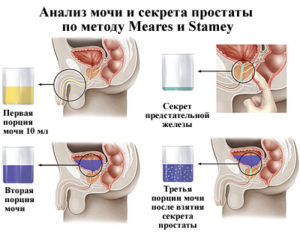 Подготовка к взятию секрета простаты. Анализ сока простаты – показания к проведению. Как проходит процедура взятия секрета простаты