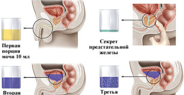 Подготовка к взятию секрета простаты. Анализ сока простаты – показания к проведению. Как проходит процедура взятия секрета простаты