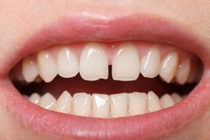 Что делать, если расходятся зубы. Почему появляется щель между передними зубами