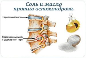 Есть ли соли в позвоночнике. Соли в позвоночнике: симптомы и лечение