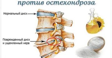 Есть ли соли в позвоночнике. Соли в позвоночнике: симптомы и лечение