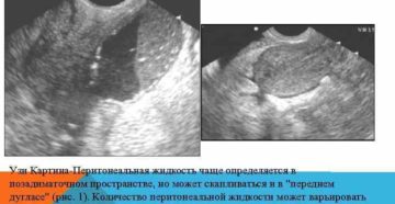 Причины появления свободной жидкости в пространстве Дугласа (позадиматочном). Если на узи обнаружили жидкость в позадиматочном пространстве