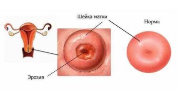 Полное выпадение матки, декубитальная язва. Как выглядит эрозия шейки матки